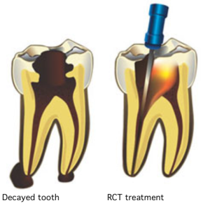 Root canal https://avedental.nl/wp-content/uploads/2022/02/Root-canal-300x300.png