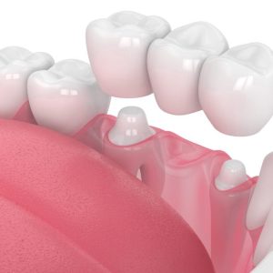 https://avedental.nl/wp-content/uploads/2023/11/Crowns-300x300.jpg