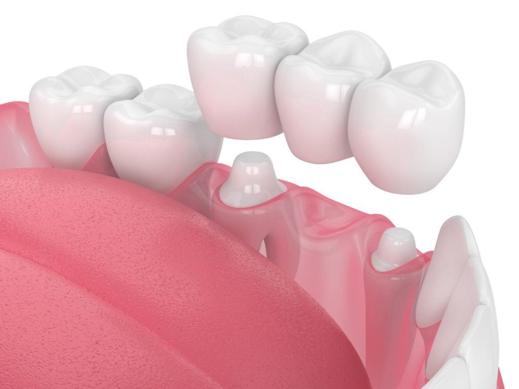 https://avedental.nl/wp-content/uploads/2023/11/Crowns.jpg