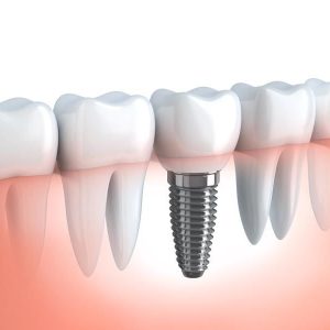 https://avedental.nl/wp-content/uploads/2023/11/Implant-300x300.jpg