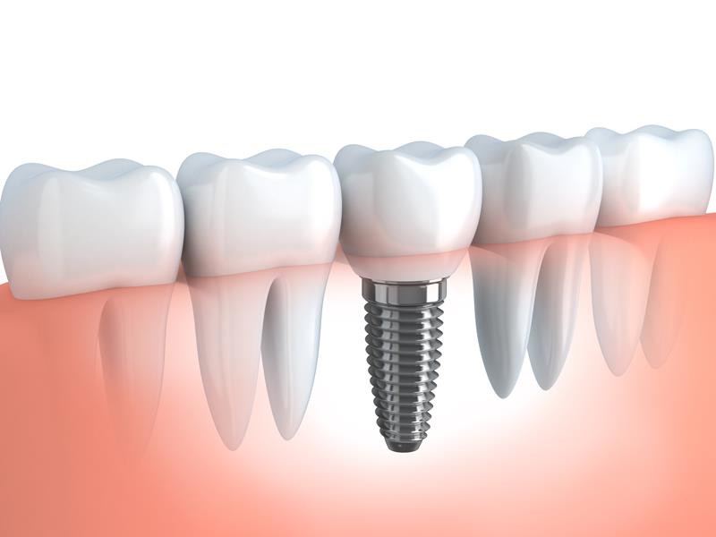 https://avedental.nl/wp-content/uploads/2023/11/Implant.jpg