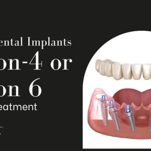 https://avedental.nl/wp-content/uploads/2023/12/Which-is-Better-All-on-4-or-All-on-6-Dental-Implants-300x300.jpeg